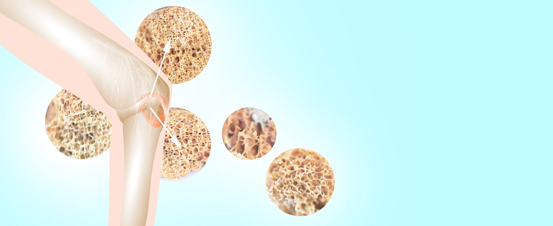 Can You Rebuild Bone Density?